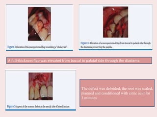 A full-thickness flap was elevated from buccal to palatal side through the diastema
The defect was debrided, the root was scaled,
planned and conditioned with citric acid for
3 minutes
 