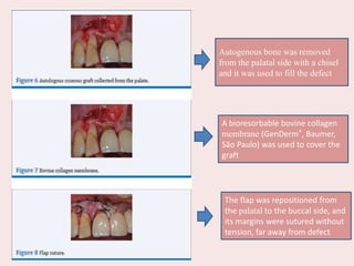 Autogenous bone was removed
from the palatal side with a chisel
and it was used to fill the defect
A bioresorbable bovine collagen
membrane (GenDerm®, Baumer,
São Paulo) was used to cover the
graft
The flap was repositioned from
the palatal to the buccal side, and
its margins were sutured without
tension, far away from defect
 