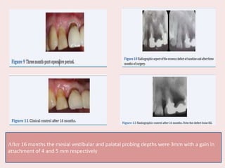 After 16 months the mesial vestibular and palatal probing depths were 3mm with a gain in
attachment of 4 and 5 mm respectively
 