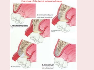 PProcedure of the lateral incision technique
 