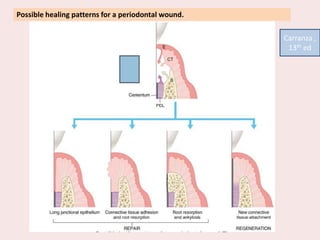 Possible healing patterns for a periodontal wound.
Carranza ,
13th ed
 