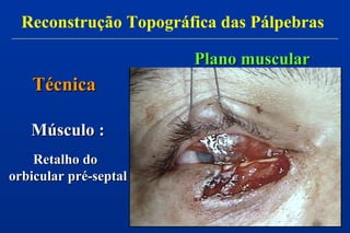 Plano muscularPlano muscular
Músculo :Músculo :
Retalho doRetalho do
orbicular pré-septalorbicular pré-septal
TécnicaTécnica
Reconstrução Topográfica das Pálpebras
 