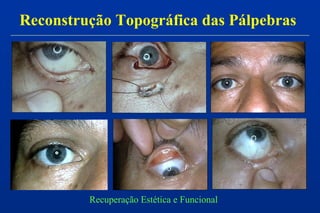 Reconstrução Topográfica das Pálpebras
Recuperação Estética e Funcional
 