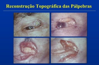 Reconstrução Topográfica das Pálpebras
 