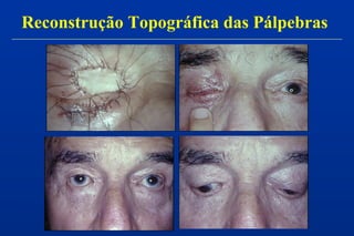 Reconstrução Topográfica das Pálpebras
 