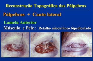Pálpebras + Canto lateralPálpebras + Canto lateral
Lamela AnteriorLamela Anterior
Músculo e Pele :Músculo e Pele : Retalho miocutâneo bipediculadoRetalho miocutâneo bipediculado
Reconstrução Topográfica das Pálpebras
 