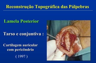 Lamela PosteriorLamela Posterior
Tarso e conjuntiva :Tarso e conjuntiva :
Cartilagem auricularCartilagem auricular
com pericôndriocom pericôndrio
( 1997 )
Reconstrução Topográfica das Pálpebras
 
