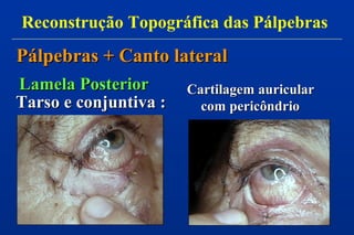 Lamela PosteriorLamela Posterior
Tarso e conjuntiva :Tarso e conjuntiva :
Cartilagem auricularCartilagem auricular
com pericôndriocom pericôndrio
Reconstrução Topográfica das Pálpebras
Pálpebras + Canto lateralPálpebras + Canto lateral
 