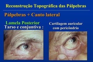 Lamela PosteriorLamela Posterior
Tarso e conjuntiva :Tarso e conjuntiva :
Cartilagem auricularCartilagem auricular
com pericôndriocom pericôndrio
Reconstrução Topográfica das Pálpebras
Pálpebras + Canto lateralPálpebras + Canto lateral
 