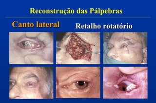 Canto lateralCanto lateral
Reconstrução das Pálpebras
Retalho rotatórioRetalho rotatório
 