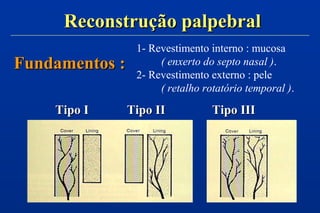 Fundamentos :Fundamentos :
Reconstrução palpebralReconstrução palpebral
1- Revestimento interno : mucosa
( enxerto do septo nasal ).
2- Revestimento externo : pele
( retalho rotatório temporal ).
Tipo ITipo I Tipo IITipo II Tipo IIITipo III
 