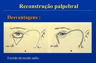Reconstrução palpebralReconstrução palpebral
Desvantagens :Desvantagens :
Excisão de tecido sadio.
 