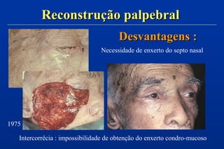 Reconstrução palpebralReconstrução palpebral
Intercorrêcia : impossibilidade de obtenção do enxerto condro-mucoso
1975
Desvantagens :Desvantagens :
Necessidade de enxerto do septo nasal
 