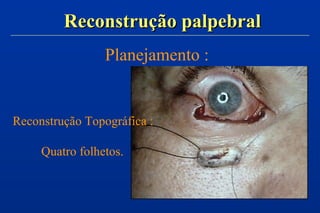 Reconstrução palpebralReconstrução palpebral
Planejamento :
Reconstrução Topográfica :
Quatro folhetos.
 
