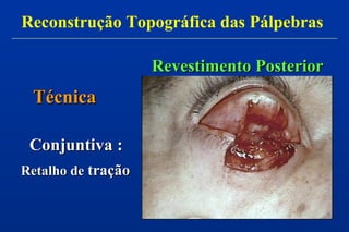 Revestimento PosteriorRevestimento Posterior
Retalho deRetalho de traçãotração
TécnicaTécnica
Conjuntiva :Conjuntiva :
Reconstrução Topográfica das Pálpebras
 