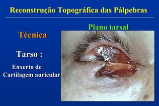 Tarso :Tarso :
Cartilagem auricularCartilagem auricular
TécnicaTécnica
Reconstrução Topográfica das Pálpebras
Plano tarsalPlano tarsal
Enxerto deEnxerto de
 
