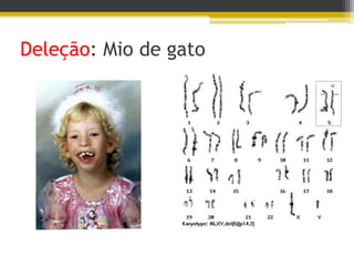 Deleção: Mio de gato
 