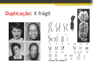 Duplicação: X frágil
 
