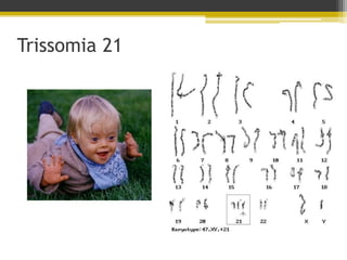 Trissomia 21
 