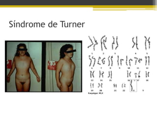 Síndrome de Turner
 