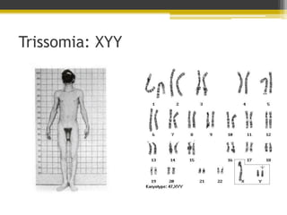 Trissomia: XYY
 