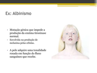 Ex: Albinismo
• Mutação génica que impede a
produção da enzima tirosinase
normal.
• Envolvida na produção de
melanina pelas células.
• A pele adquire uma tonalidade
rosada em função do fluxo
sanguíneo que recebe.
 