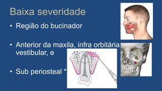 Baixa severidade
• Região do bucinador
• Anterior da maxila, infra orbitária
vestibular, e
• Sub periosteal *
 