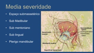 Media severidade
• Espaço submassetérico
• Sub Madibular
• Sub mentoniano
• Sub lingual
• Pterigo mandibular
 