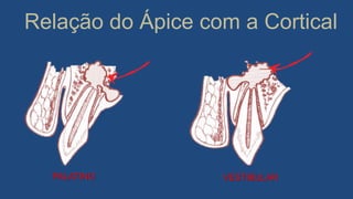 Relação do Ápice com a Cortical
VESTIBULARPALATINO
 
