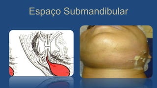 Espaço Submandibular
 