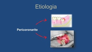 Etiologia
Pericoronarite
 