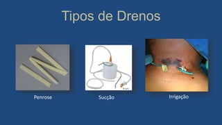 Tipos de Drenos
Penrose Sucção Irrigação
 