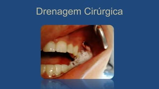 Drenagem Cirúrgica
 