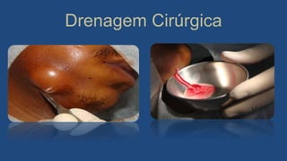 Drenagem Cirúrgica
 
