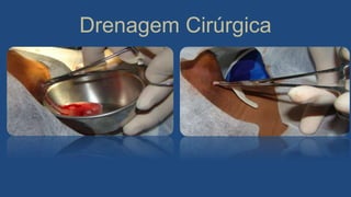 Drenagem Cirúrgica
 