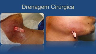 Drenagem Cirúrgica
 