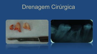 Drenagem Cirúrgica
 