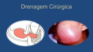 Drenagem Cirúrgica
 