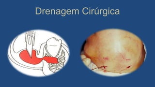 Drenagem Cirúrgica
 