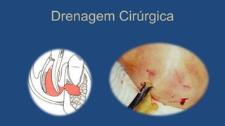 Drenagem Cirúrgica
 