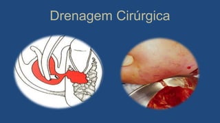 Drenagem Cirúrgica
 