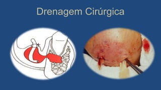Drenagem Cirúrgica
 