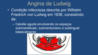 Angina de Ludwig
• Condição infecciosa descrita por Wilhelm
Friedrich von Ludwig em 1836, consistindo
de:
– Celulite aguda envolvendo os espaços
submandibular, submentoniano e sublingual
bilateralmente
 