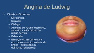 Angina de Ludwig
• Sinais e Sintomas:
– Dor cervical
– Dispnéia
– Disfagia
– Aumento de volume edurecido,
simétrico e eritematoso da
região cervical
– Febre alta
– Elevação do assoalho bucal
com deslocamento posterior da
língua – dificuldade ou
obstrução respiratória
 