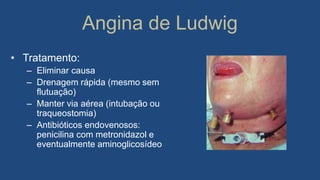 Angina de Ludwig
• Tratamento:
– Eliminar causa
– Drenagem rápida (mesmo sem
flutuação)
– Manter via aérea (intubação ou
traqueostomia)
– Antibióticos endovenosos:
penicilina com metronidazol e
eventualmente aminoglicosídeo
 