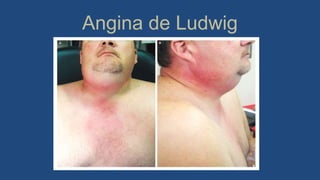 Angina de Ludwig
 