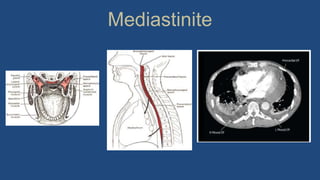 Mediastinite
 