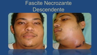Fascite Necrozante
Descendente
 