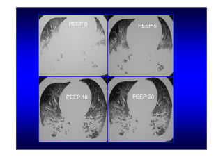 PEEP 0     PEEP 5




PEEP 10   PEEP 20
 