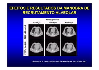 EFEITOS E RESULTADOS DA MANOBRA DE
      RECRUTAMENTO ALVEOLAR




         Gattinoni et. al. - Am J Respir Crit Care Med Vol 164. pp 131–140, 2001
                       al.                                         131–
 